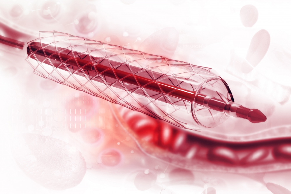 Stent angioplasty. 3d illustration