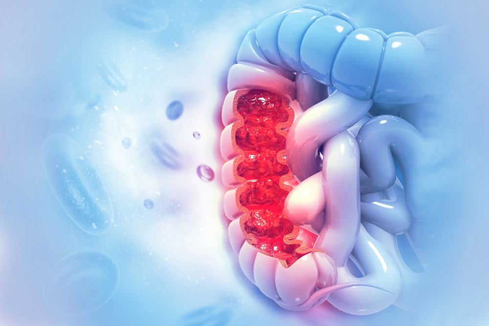 Colon cancer. Colon disease concept. 3d illustration